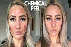 How to Care for Your Skin After a Chemical Peel A Comprehensive Guide